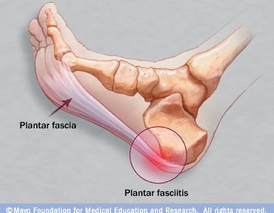 Fascite plantare