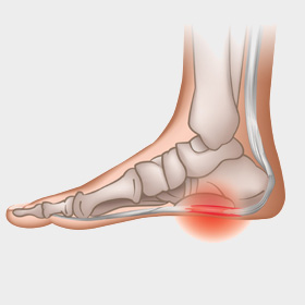 fascite_plantare.jpg image